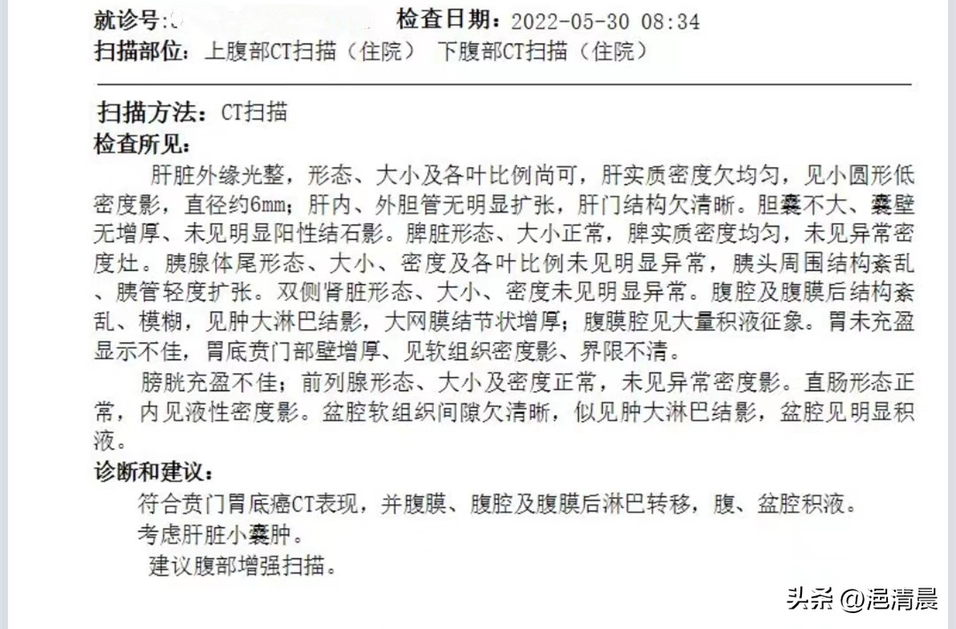 针对恶性腹水，腹腔灌注化疗显奇效