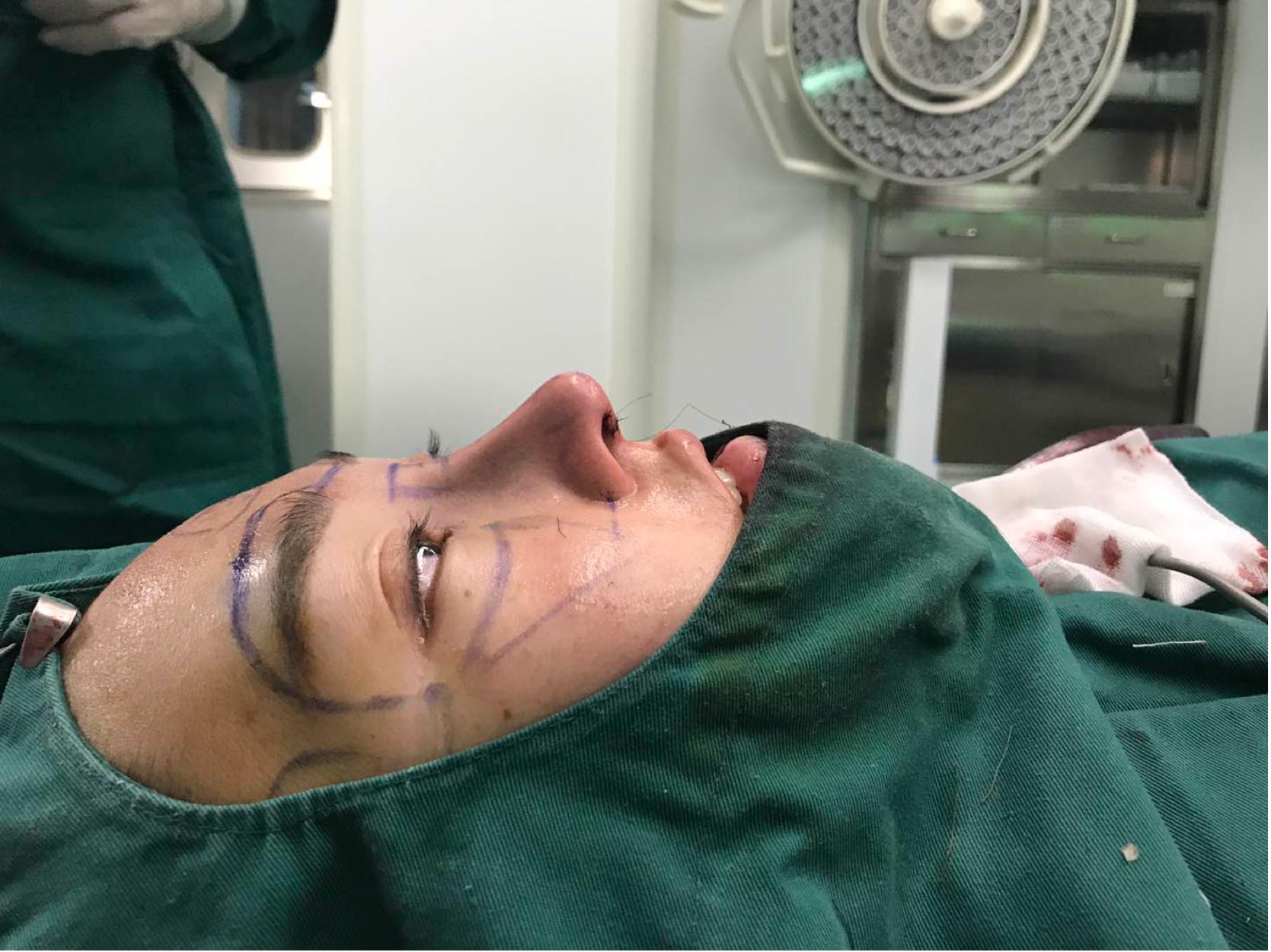 垫鼻基底去除法令纹方法,垫了鼻基底法令纹还是很深怎么办