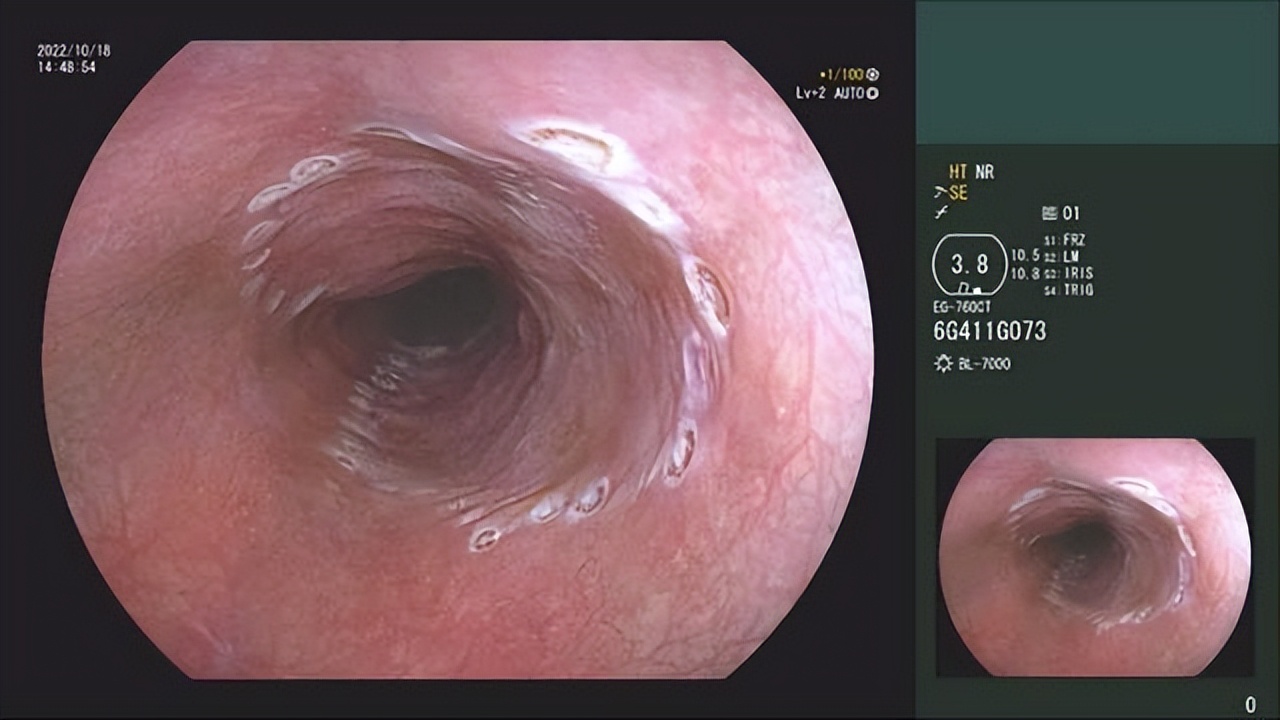 西安市红会医院：七旬老人患食管癌消化内科内镜黏膜下剥离术除烦恼
