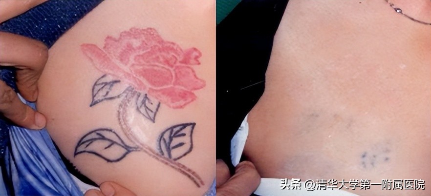 来深度了解皮秒激光美白祛斑效果,一起美起来