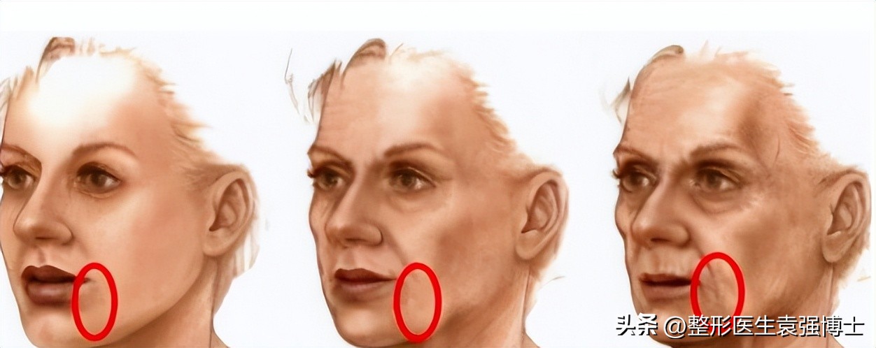 面部皮肤松弛形成口角囊袋,口角囊袋是皮肤松弛的结果吗