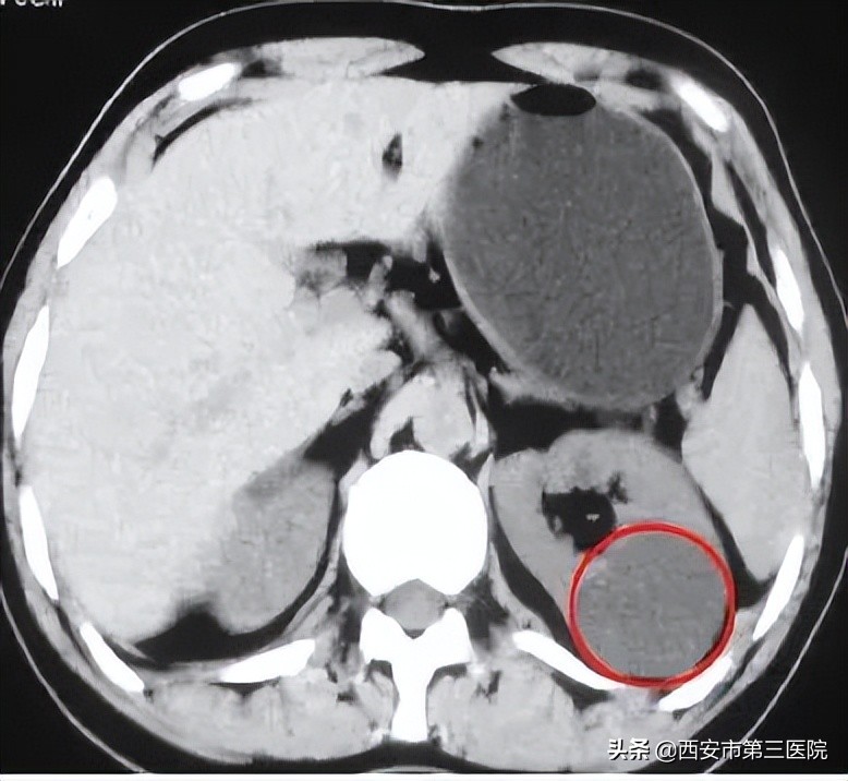 肾囊肿跟肿瘤有什么区别,囊肿在检查过程中破了会怎样