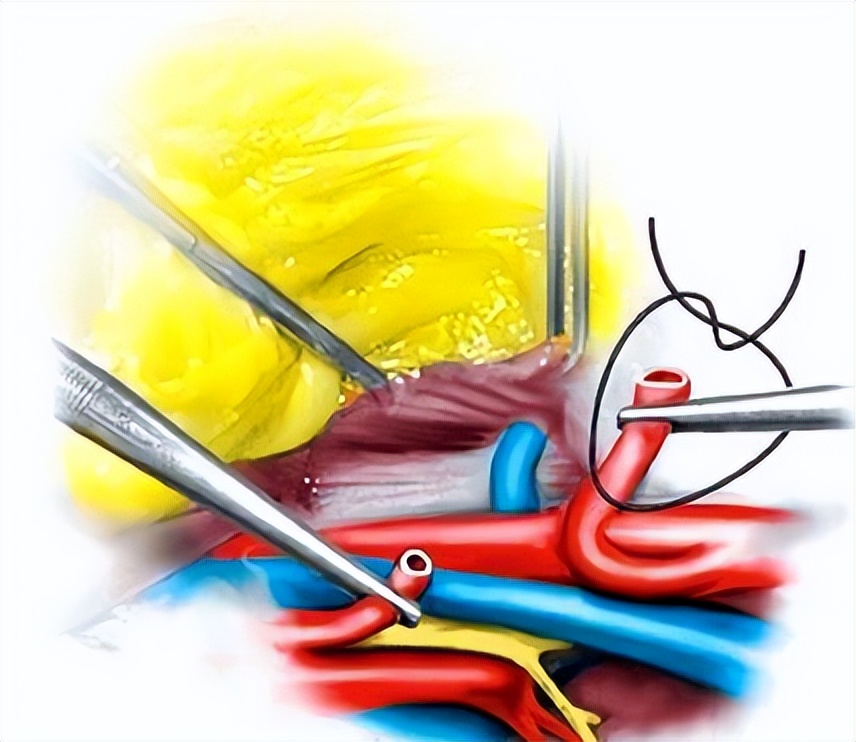 为什么手术划开皮肤不会流血,不小心割到皮一直流血怎么办