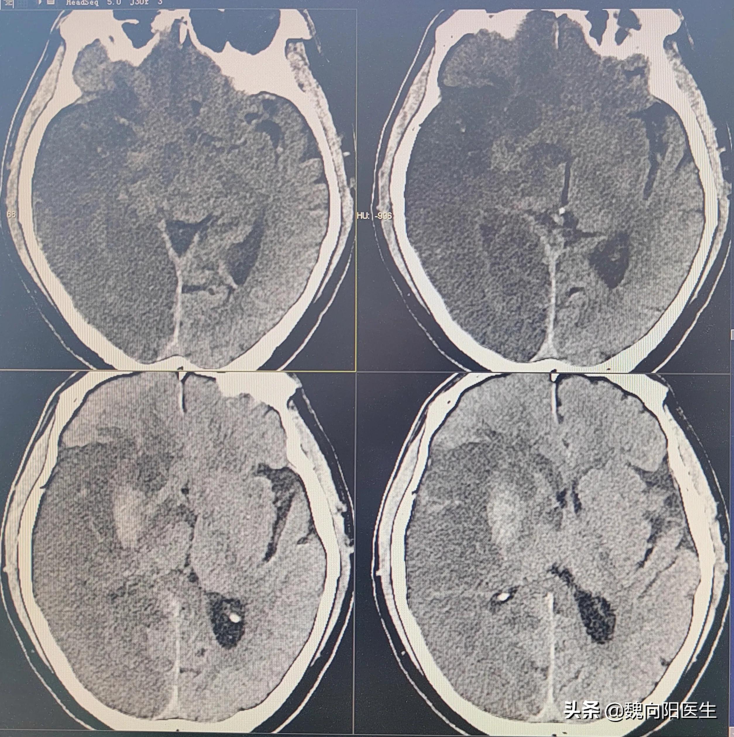 脑血栓抢救,脑血栓免费康复训练