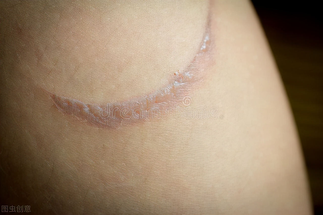 家人被烧伤、烫伤，怎么办？建议每个人都收藏的急救小知识