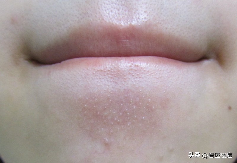 脸上的闭口粉刺怎么去除简单方法,闭口粉刺和闭口的区别