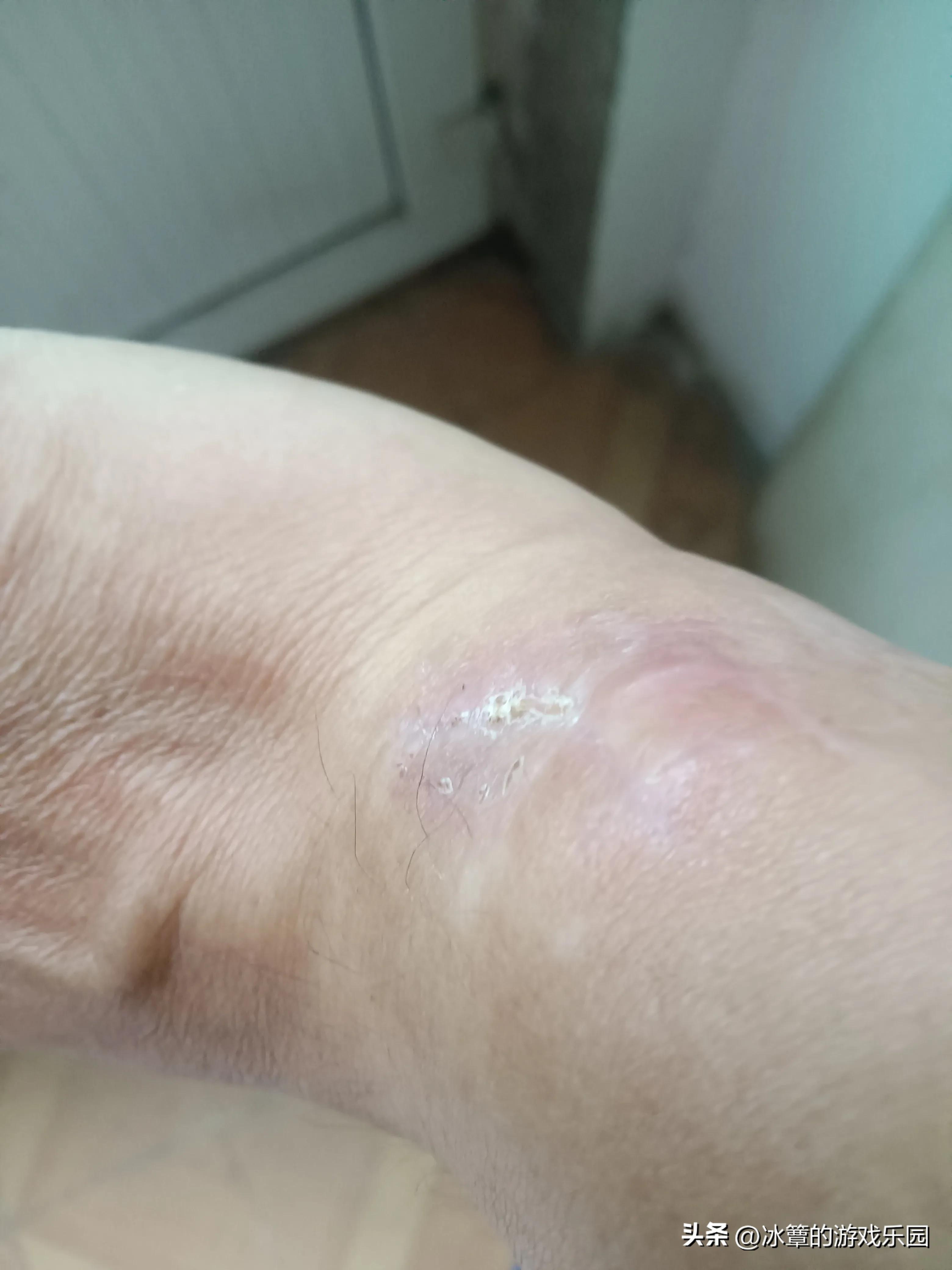 出院拔针,再次住院要相隔多少天才能报销