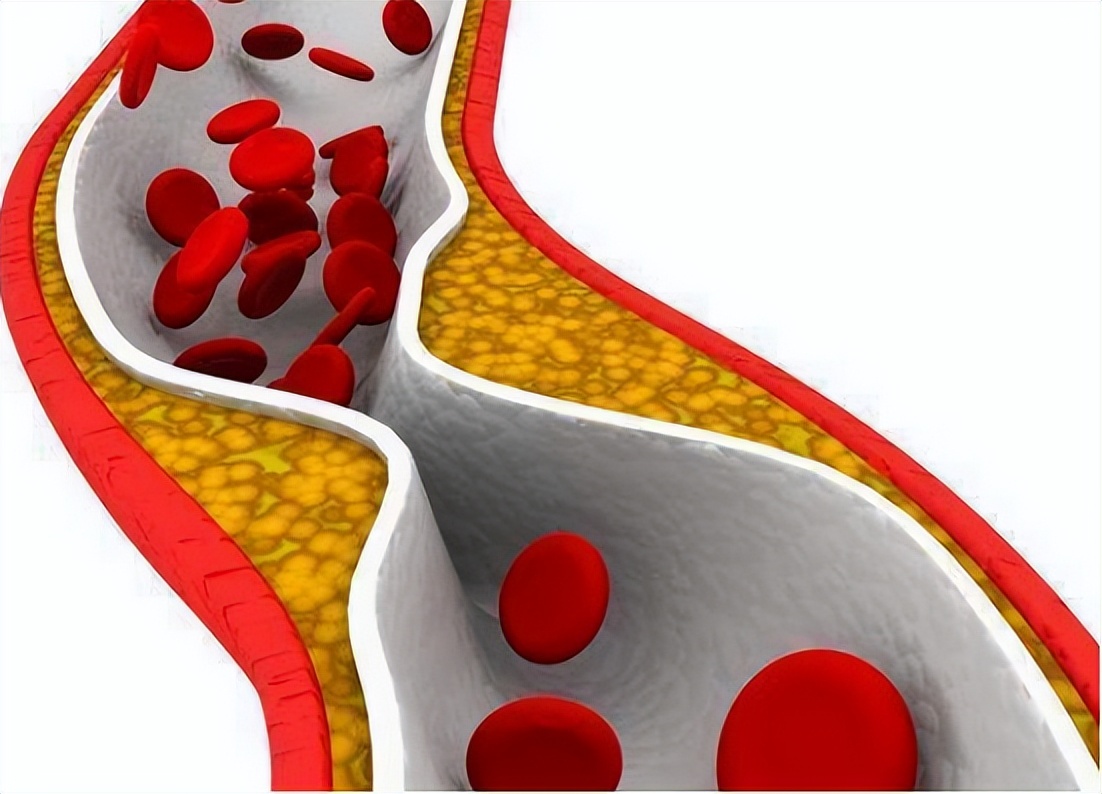 冠心病诊断预测模型,建模预测冠心病