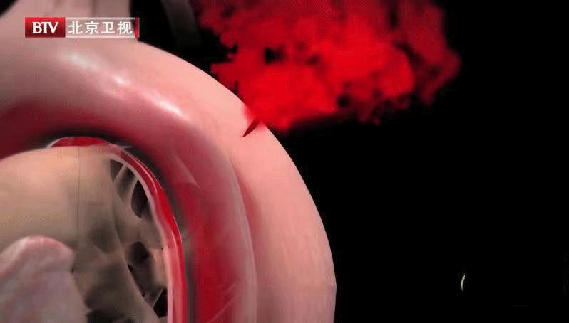 排便用力导致脑出血案例,排便太用力会有多危险需引起警惕