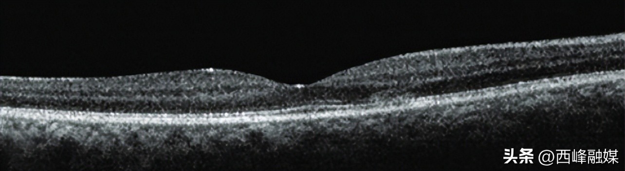 眼睛感染阳了症状,感染后眼睛疼怎么办