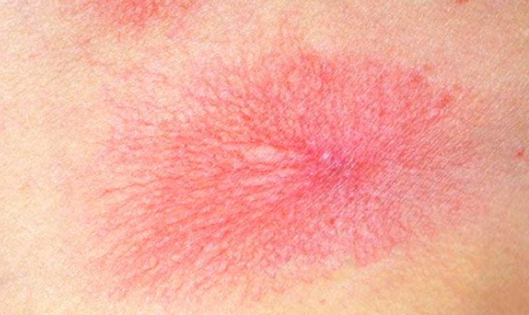 有红点很可能是肝病恶化了,出现这些红点可能是肝硬化