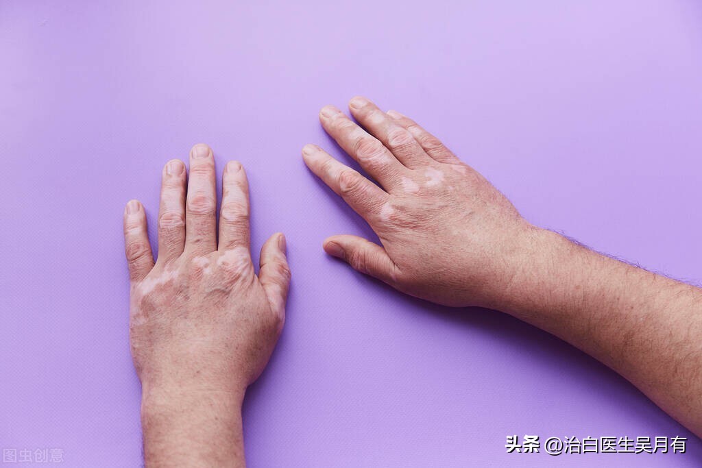 早期白癜风多久见效,早期白癜风需要多久能治好