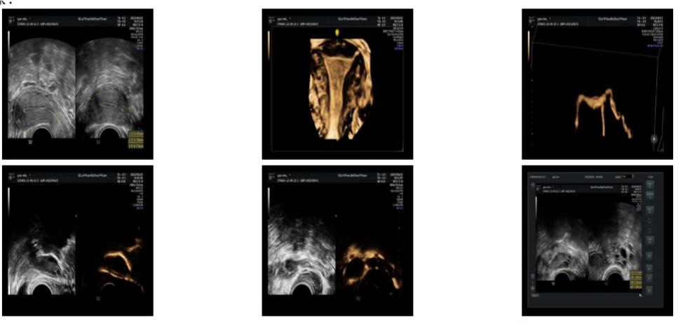 德医生殖医学科再获锦旗！子宫输卵管四维超声造影助好“孕”