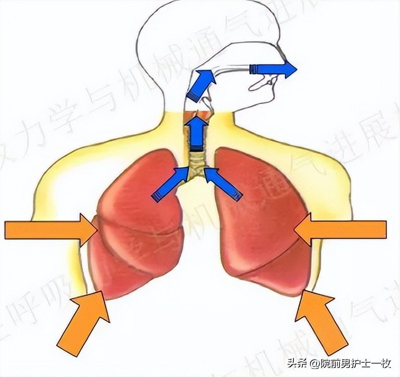 呼吸机应用详解机械通气临床实战,机械通气患者的护理