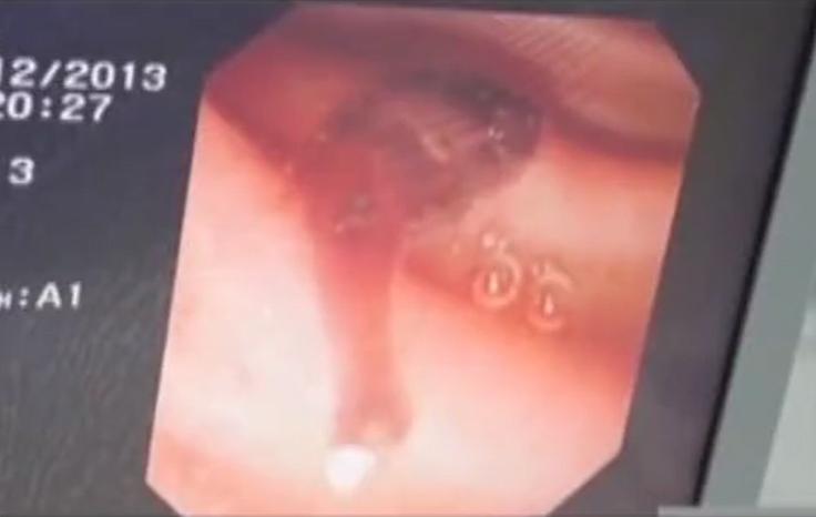 故事：湖北55岁男子病从口入，孕出成千上万虫卵，肚子竟成虫窝