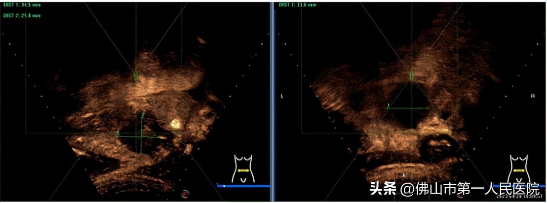 海扶刀手术治疗胰腺癌怎么样,胰腺癌海扶刀手术多长时间