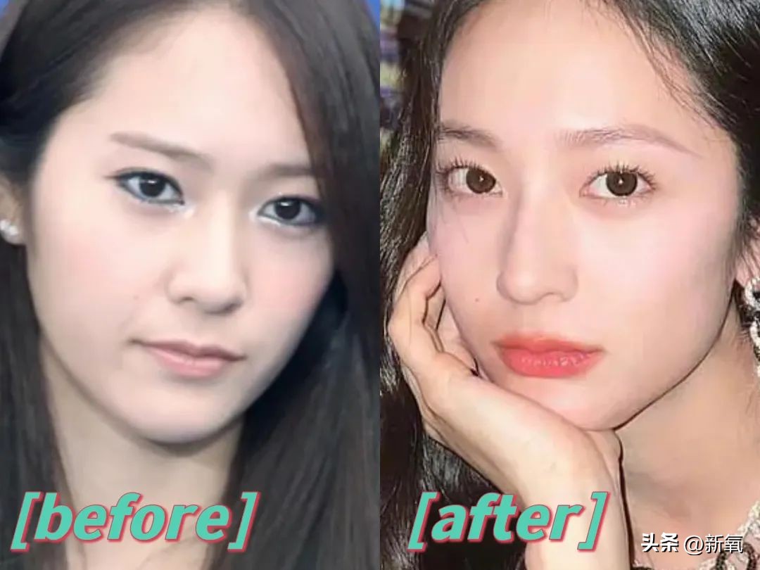 嘴唇薄变丰满,嘴唇变凸变丑怎么办