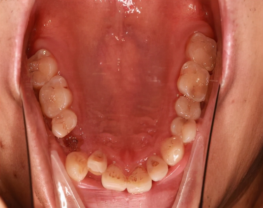 年轻人缺一两颗牙要管吗？真要管