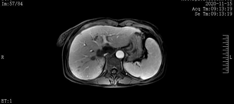 病例实录|免疫联合方案治疗胰腺癌多发转移的病例分享