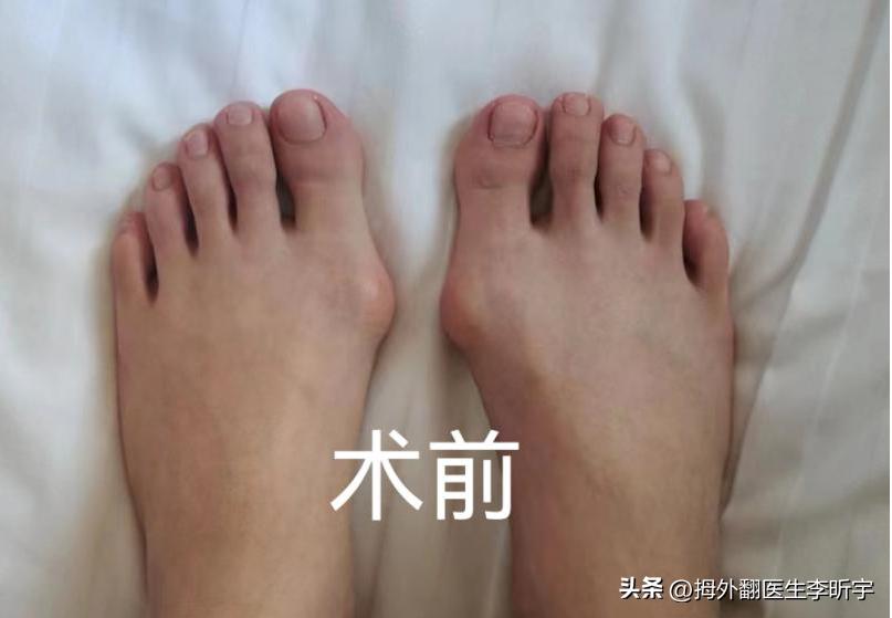 遗传性拇外翻能矫正过来吗,遗传性脚趾拇外翻怎么避免