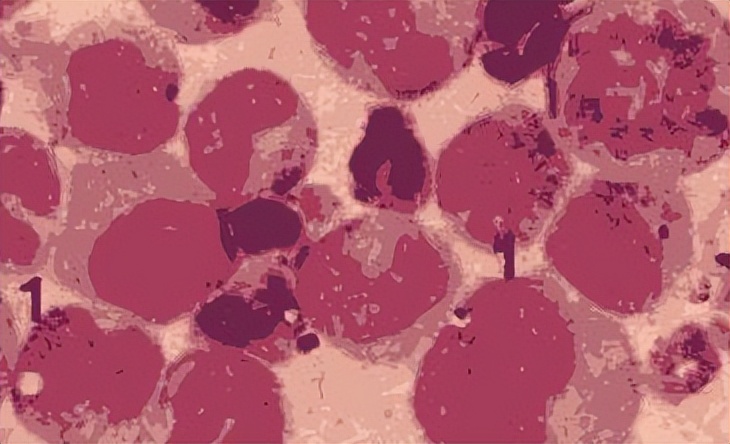 中世纪败血症,败血病是什么