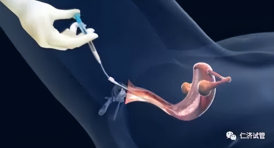 人工授精症状,人工授精适应症和禁忌症简答题