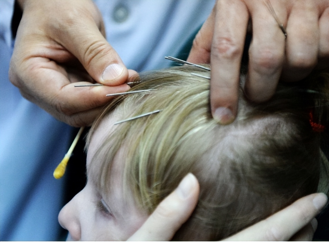 脑瘫中医针灸,针灸治疗小儿脑瘫的理论依据