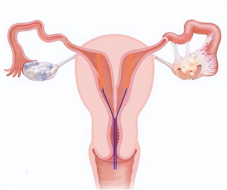 意外怀孕多久做无痛人流手术,怀孕36天无痛人流真实经历