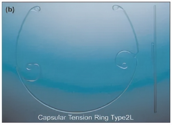 囊袋张力环植入过程,囊袋张力环优缺点