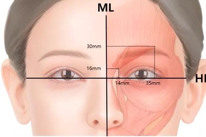 精准注射：如何用更少剂量肉毒毒素处理眉间纹？