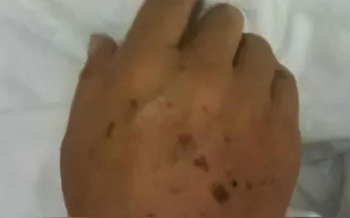 老年色素沉着斑怎么消除,色素沉着老年斑能去除吗