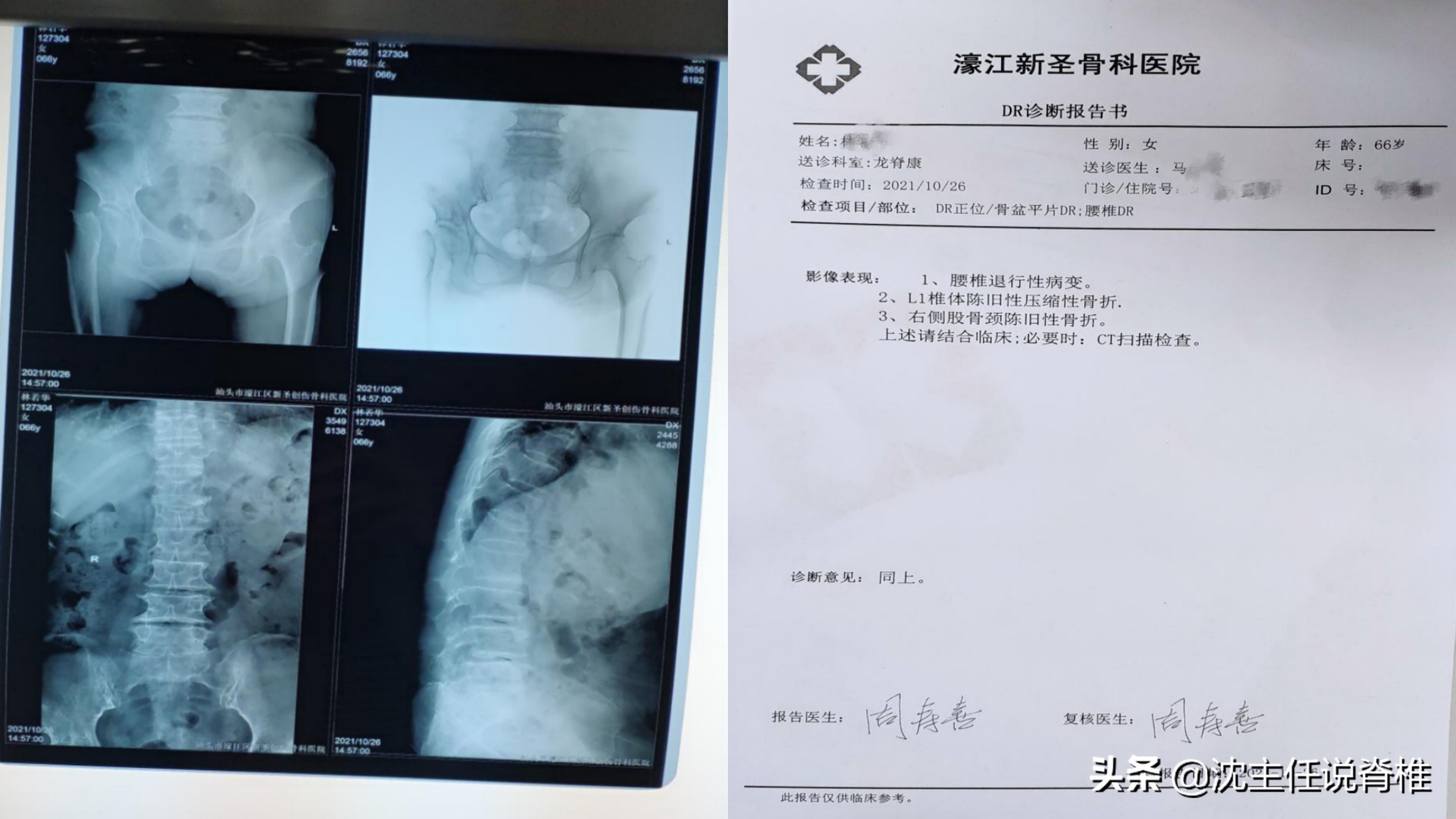 老人摔倒股骨颈骨折最佳治疗方案,老年偏瘫侧股骨颈骨折怎么办