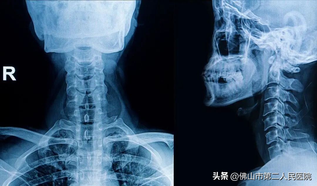 腰椎错位？快试试这种轻巧、无痛、安全有效的复位手法吧！