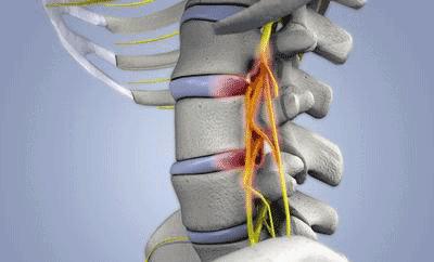 腰椎间盘突出焦虑,得了腰间盘突出需要注意什么