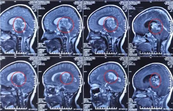 七岁男孩新长出的牙齿都有锯齿,7岁男孩朝上长一颗牙