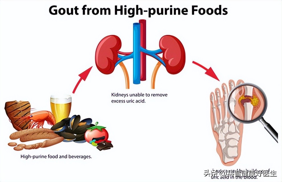 2022全国高尿酸有多少人,全国有多少高尿酸的人