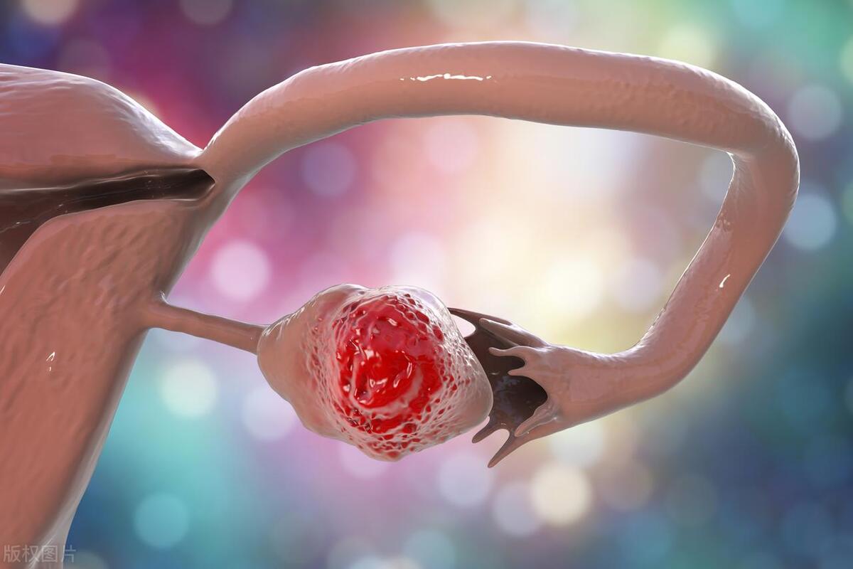 卵巢癌为什么发现就是晚期,卵巢癌一发现就是晚期