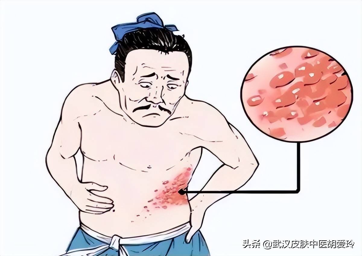 腰部左后侧疼痛起水泡,咳嗽咳的腰部右侧位疼
