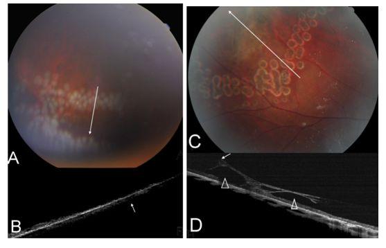 本想做近视手术，却发现眼底上破了个“洞”！需不需要治疗？