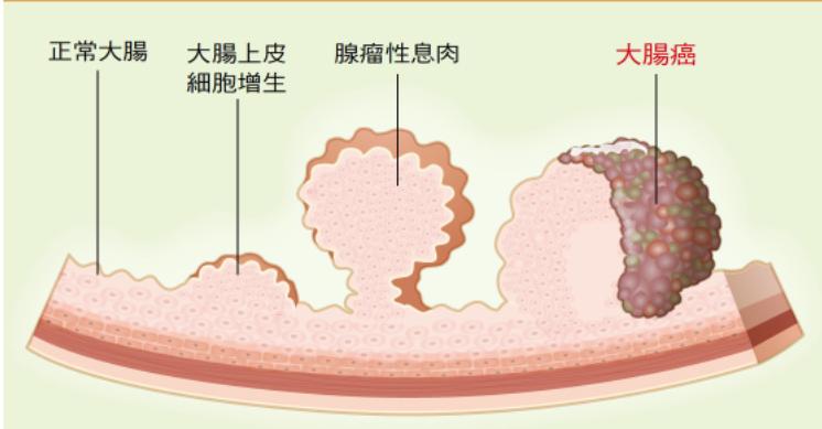 肠道多发息肉还是单发息肉严重,肠道扁平息肉厉害还是息肉厉害