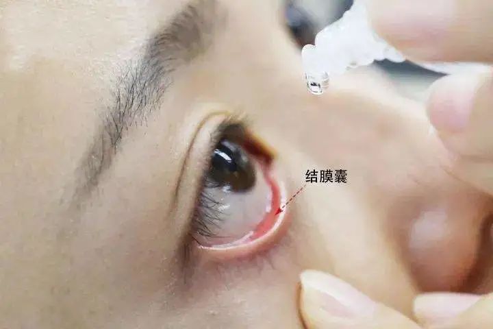 隐形眼镜好像掉眼睛里但是找不到,透明隐形眼镜掉在眼睛了怎么找