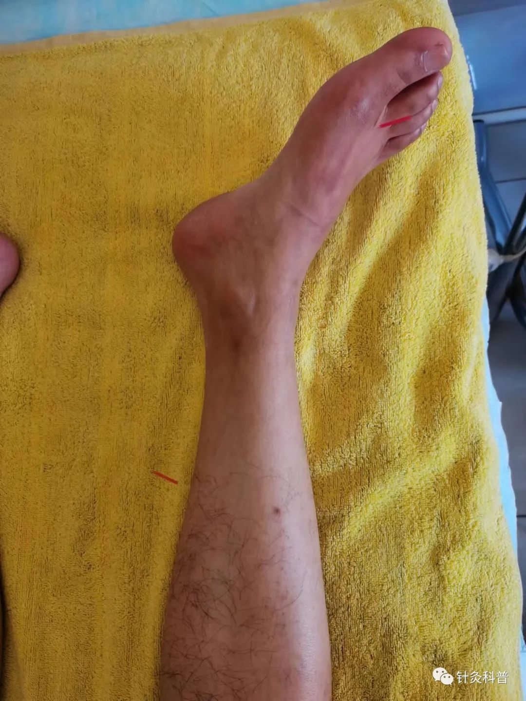 针灸治疗偏头痛的经方,针灸后偏头痛是怎么回事