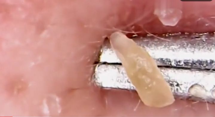 鼻子上挤出来的白色东西如何去除,鼻子上挤出来的白色分泌物是什么