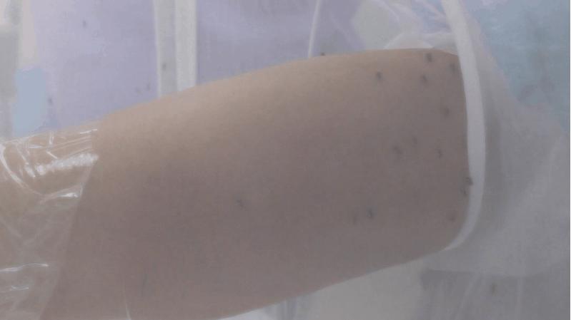 蚊子叮咬止痒消肿膏推荐,蚊虫叮咬止痒药膏测评推荐