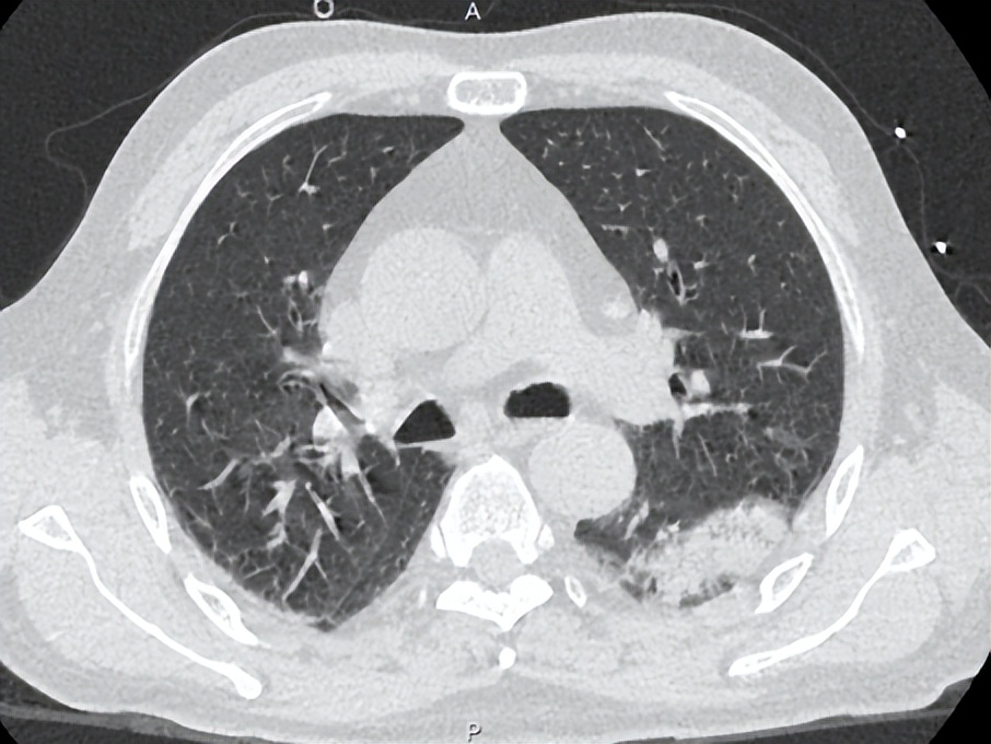 脓毒症住院五天接着发烧,脓毒症体温下降