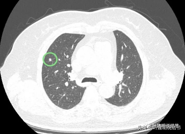 肺结节实性为什么建议抗炎治疗,肺上实性结节抗炎后变成空洞
