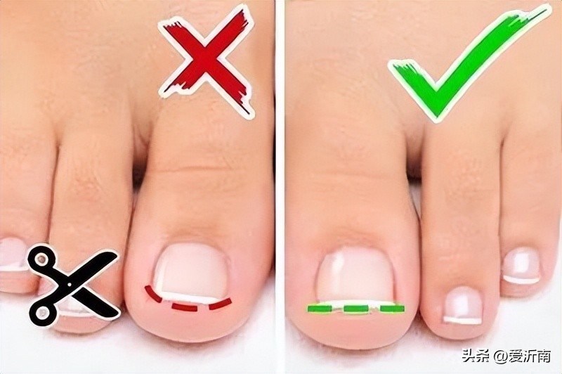 脚趾甲沟炎肿了怎么办一碰就疼,甲沟炎把指甲拔了还是肿