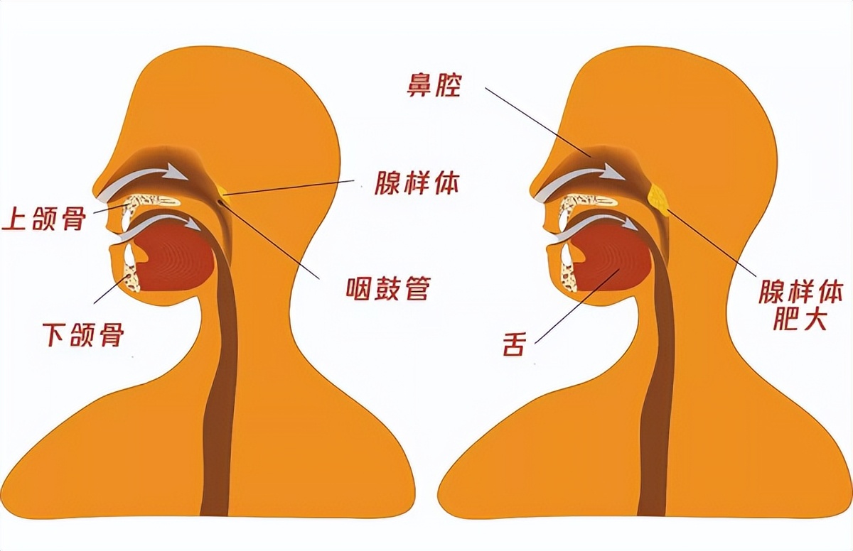 孩子腺样体肥大鼻窦炎家长经验,家长自测儿童腺样体肥大