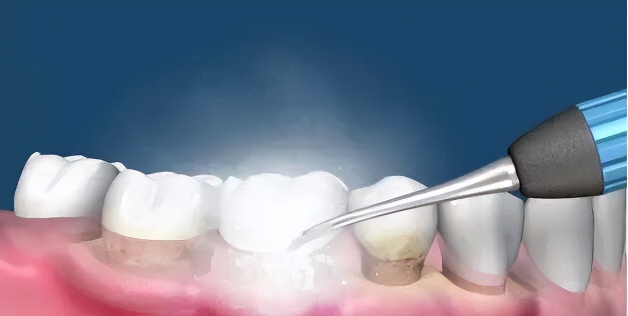 超声波洗牙喷砂和抛光什么意思,赣州洗牙抛光喷砂一起大概多少钱