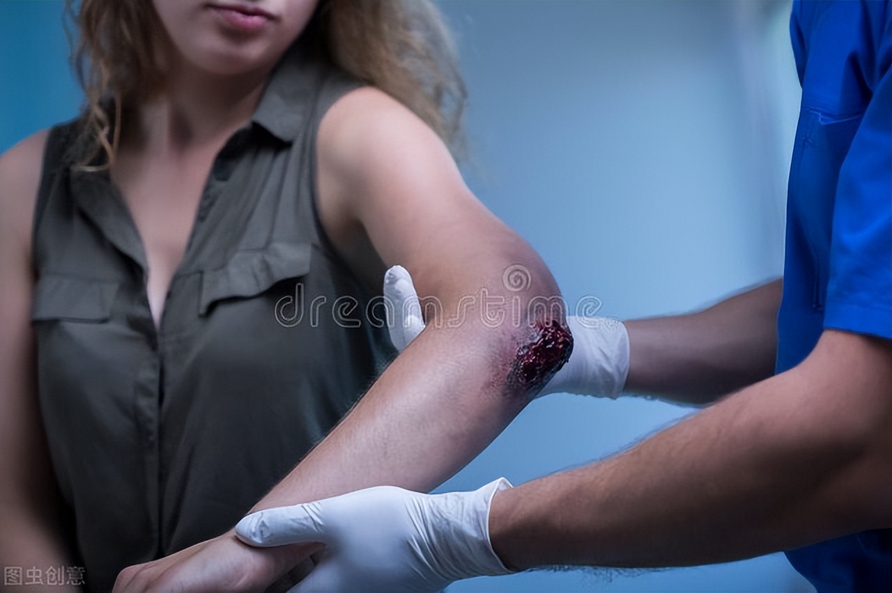 微轻伤和轻微伤的区别,脱臼算轻伤还是轻微伤